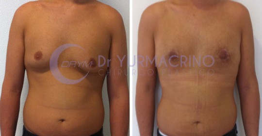 Gynecomastia – Case 5/A