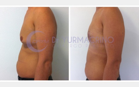 Gynecomastia – Case 5/C