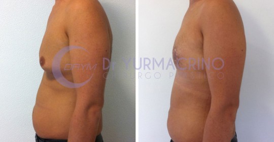 Gynecomastia – Case 5/C