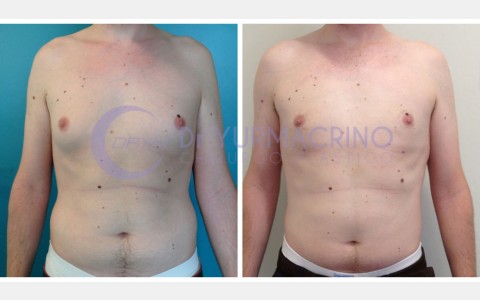 Gynecomastia – Case 6/A