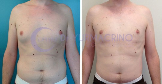 Gynecomastia – Case 6/A