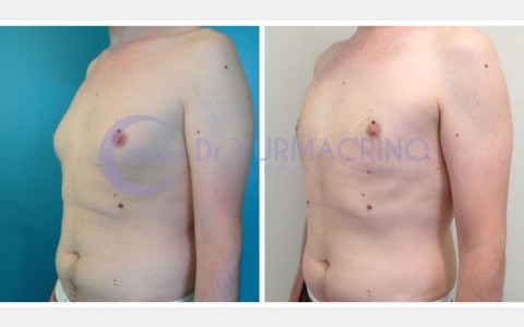 Gynecomastia – Case 6/B