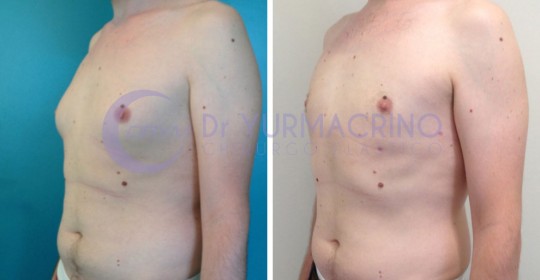 Gynecomastia – Case 6/B