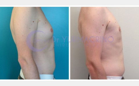 Gynecomastia – Case 6/C