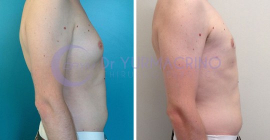 Gynecomastia – Case 6/C