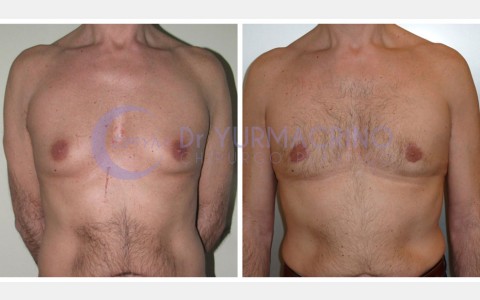 Gynecomastia – Case 7/A