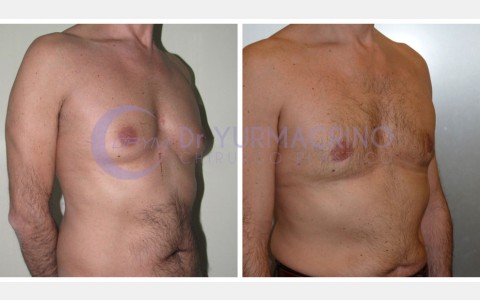 Gynecomastia – Case 7/B