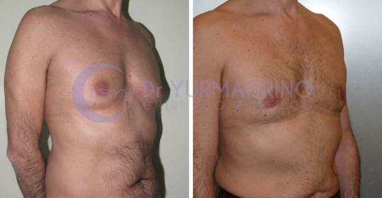 Gynecomastia – Case 7/B