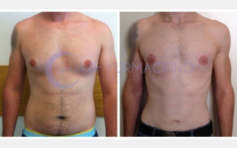 Gynecomastia – Case 8/A