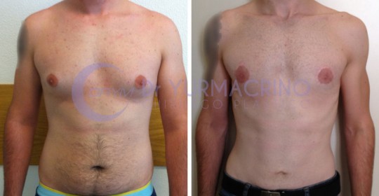 Gynecomastia – Case 8/A