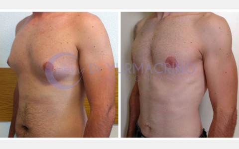 Gynecomastia – Case 8/B