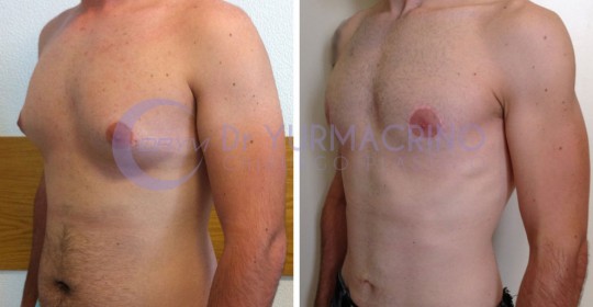 Gynecomastia – Case 8/B