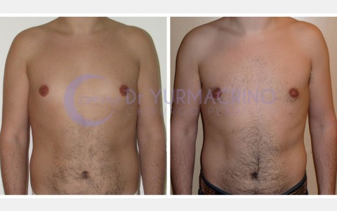 Gynecomastia – Case 9/A