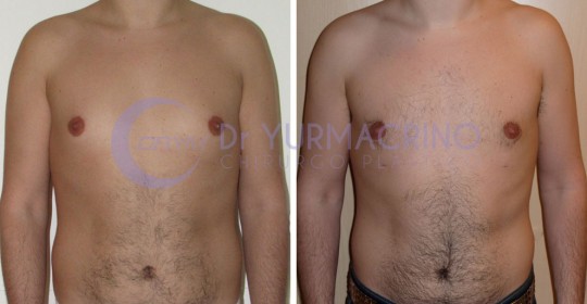 Gynecomastia – Case 9/A