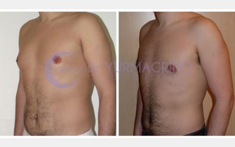 Gynecomastia – Case 9/B