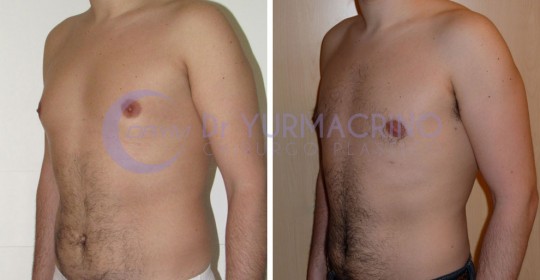 Gynecomastia – Case 9/B