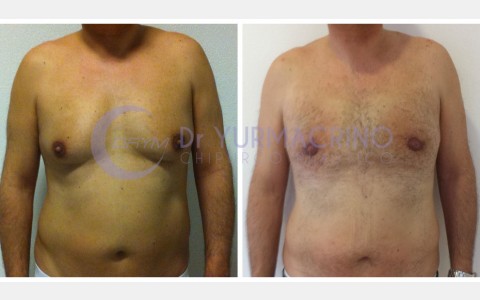 Gynecomastia – Case 10/A