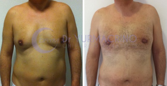 Gynecomastia – Case 10/A