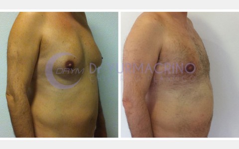 Gynecomastia – Case 10/B