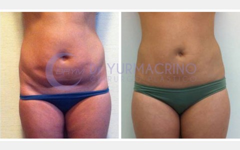 Abdomen/Hips Liposculpture – Case 1/A