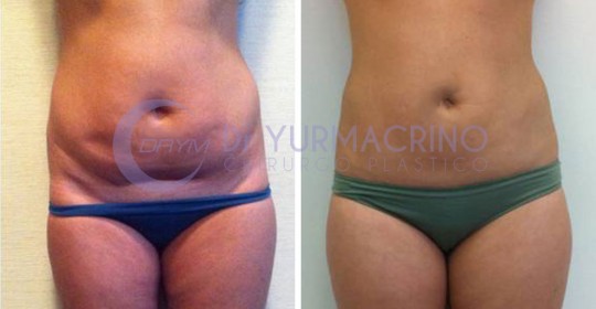 Abdomen/Hips Liposculpture – Case 1/A