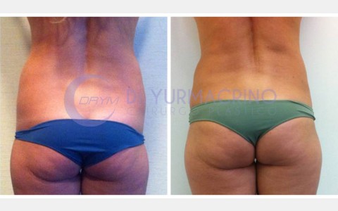 Abdomen/Hips Liposculpture – Case 1/B