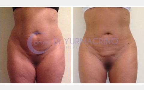 Abdomen/Hips Liposculpture – Case 2/A