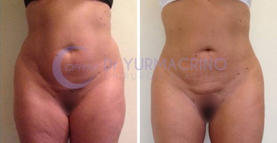 Abdomen/Hips Liposculpture – Case 2/A