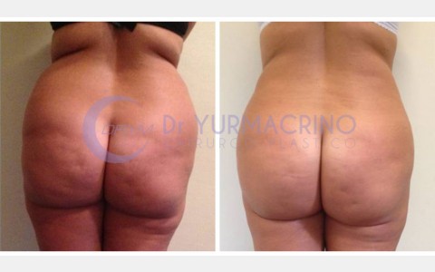 Abdomen/Hips Liposculpture – Case 2/B