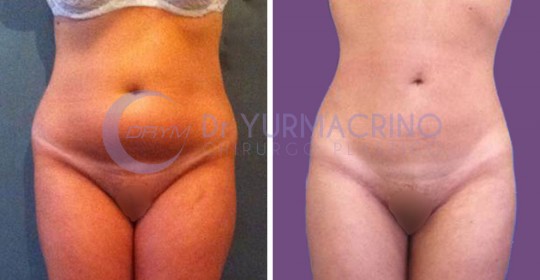 Abdomen/Hips Liposculpture – Case 3/A