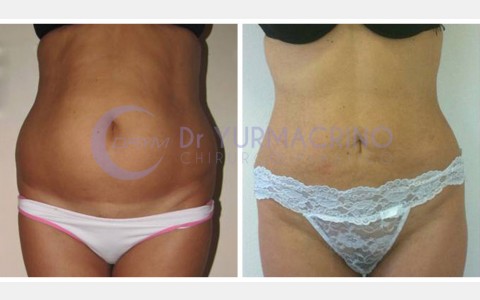 Abdomen/Hips Liposculpture – Case 4/A