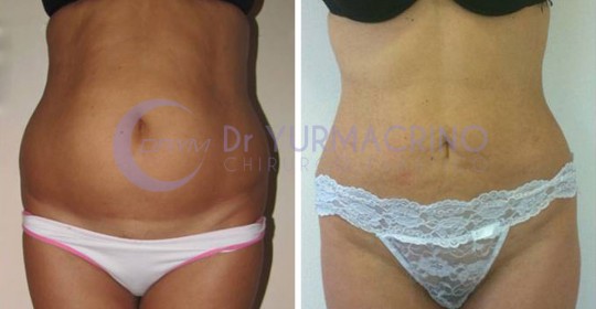 Abdomen/Hips Liposculpture – Case 4/A