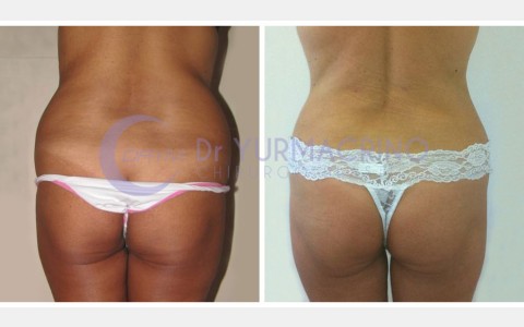 Abdomen/Hips Liposculpture – Case 4/B