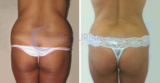 Abdomen/Hips Liposculpture – Case 4/B