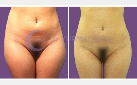 Abdomen/Hips Liposculpture – Case 5/A