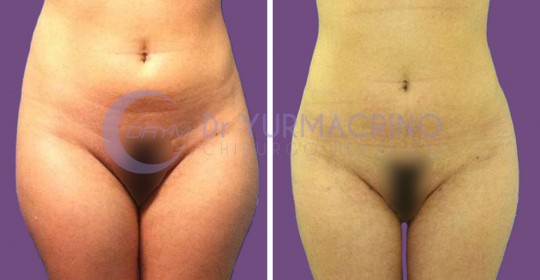 Abdomen/Hips Liposculpture – Case 5/A