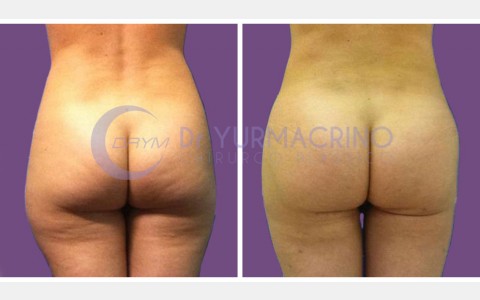 Abdomen/Hips Liposculpture – Case 5/B