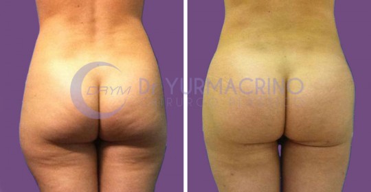 Abdomen/Hips Liposculpture – Case 5/B