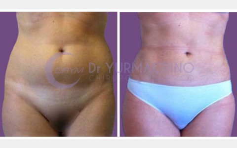 Abdomen/Hips Liposculpture – Case 6/A