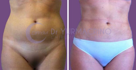 Abdomen/Hips Liposculpture – Case 6/A