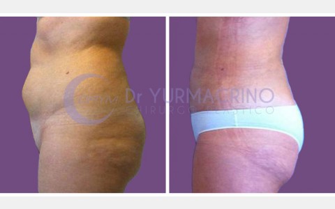 Abdomen/Hips Liposculpture – Case 6/B