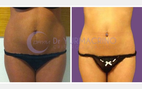 Abdomen/Hips Liposculpture – Case 7/A