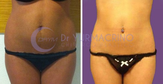 Abdomen/Hips Liposculpture – Case 7/A