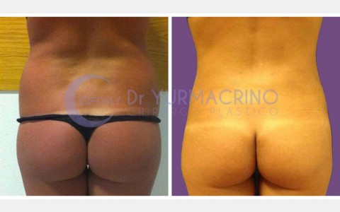 Abdomen/Hips Liposculpture – Case 7/B