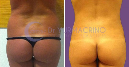 Abdomen/Hips Liposculpture – Case 7/B