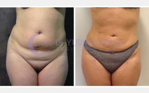 Abdomen/Hips Liposculpture – Case 8/A