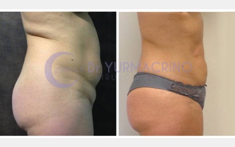 Abdomen/Hips Liposculpture – Case 8/B