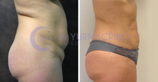 Abdomen/Hips Liposculpture – Case 8/B