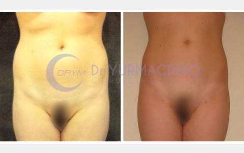 Abdomen/Hips Liposculpture – Case 9/A