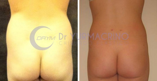 Abdomen/Hips Liposculpture – Case 9/B